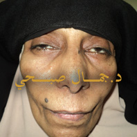 الشلل المتطور لعضلات العينChronic Progressive External Ophthalmoplegia